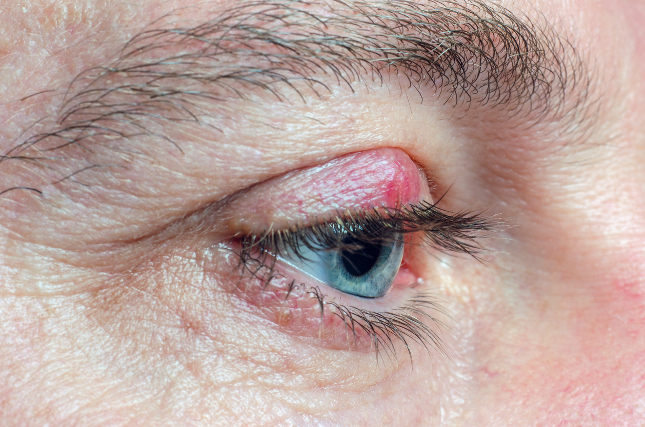 Calázio no olho - causas, sintomas, tratamento, cirurgia