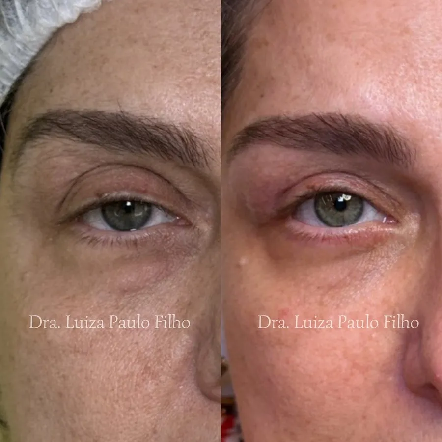 Olhos de uma mulher de 61 anos antes da cirurgia de ptose com blefaroplastia, com a pálpebra cobrindo parte da íris, e depois, com a pálpebra mais alta e a íris aparente acima da pupila
