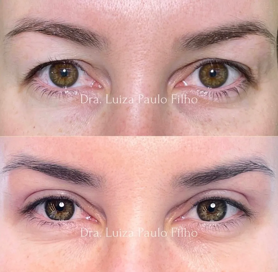 Olhos de uma mulher de 38 anos antes da blefaroplastia superior, com a pele da pálpebra encostando nos cílios, e depois, com a dobra da pálpebra aparente e o olhar mais aberto