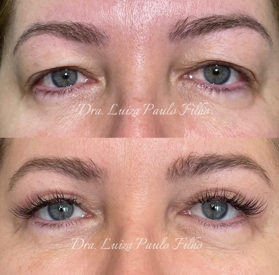 Olhos de uma mulher de 51 anos antes da blefaroplastia superior, com a pele da pálpebra superior pesando sobre os cílios, e depois, com a pálpebra mais livre e extensão de cílios
