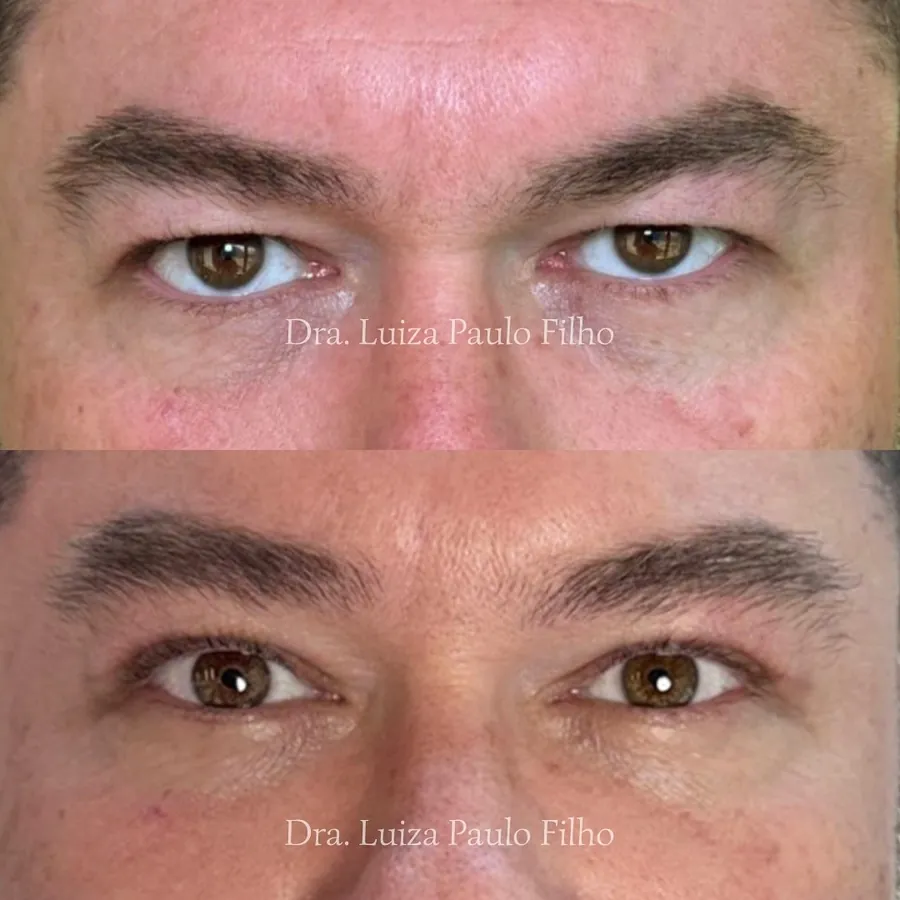 Olhos de um homem de 46 anos antes da blefaroplastia superior, com a pele da pálpebra caindo sobre os cílios, e um mês depois, com a pálpebra mais livre e a cicatriz rosada