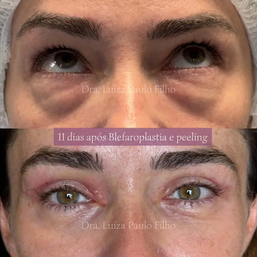Olhos de uma mulher de 41 anos antes da blefaroplastia, com bolsas de gordura marcadas nas pálpebras inferiores, e 11 dias depois, com as bolsas reduzidas e a cicatriz superior ainda rosada