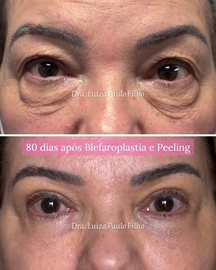 Olhos de uma mulher de 64 anos antes da blefaroplastia, com pele sobrando nas pálpebras superiores e bolsas e rugas nas inferiores, e 80 dias depois, com as pálpebras mais lisas e sem as bolsas