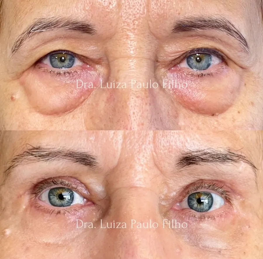 Olhos de uma mulher de 64 anos antes da cirurgia, com bolsas de gordura grandes nas pálpebras inferiores e pele caída nas superiores, e um mês depois, sem as bolsas e com o olhar mais aberto