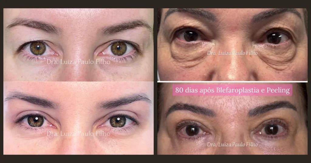 Dois antes e depois reais de blefaroplastia: superior (38 anos) e superior + inferior (64 anos, 80 dias)