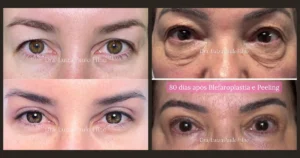 Dois antes e depois reais de blefaroplastia: superior (38 anos) e superior + inferior (64 anos, 80 dias)