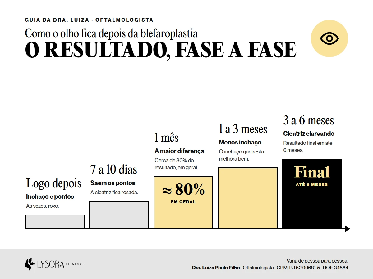 Linha do tempo do resultado da blefaroplastia: logo depois inchaço e pontos, 7 a 10 dias retirada dos pontos, 1 mês cerca de 80% do resultado, 3 a 6 meses cicatriz clareando e resultado final em até 6 meses