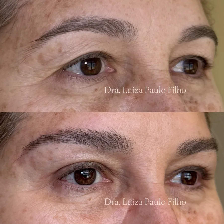 Olhos de uma mulher de 57 anos antes do lifting de sobrancelha com blefaroplastia superior, com sobrancelhas baixas e pele pesada sobre os olhos, e depois, com a cauda da sobrancelha mais alta e a pálpebra mais livre